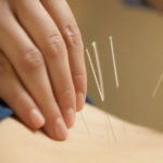 acupuntura en fkt centro medico, lomas de zamora, atencion con obras sociales lomas de zamora